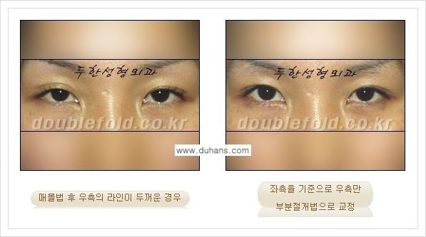 [두한성형외과 경쟁력 눈성형] - [짝짝이(비대칭) 쌍꺼풀 라인 교정하는 방법 안내 1.] 관련 이미지 2