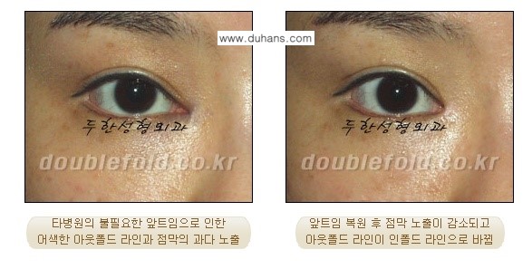 [두한성형외과 쌍꺼풀 재수술] - [과도한 앞트임이 되어있을 경우의 문제] 관련 이미지 3