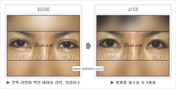 [두한성형외과 쌍꺼풀 재수술] - [쌍꺼풀 재수술에서 잘못된 수술로 인한 넓어진 흉터 처리 문제] 관련 이미지 5