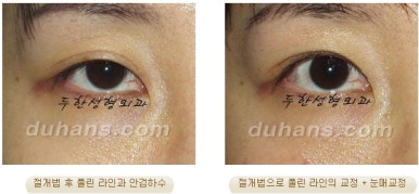 두한성형외과 눈재수술 - 쌍꺼풀 재수술 방법 관련 이미지 19