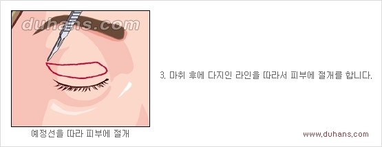 [두한성형외과 경쟁력 안검성형] - [젊고 아름다운 눈매 상안검 성형술 안내] 관련 이미지 3