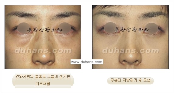 [두한성형외과 경쟁력 지방제거, 지방재배치] - [상큼하고 젊은 눈매 만들기 안내] 관련 이미지 23
