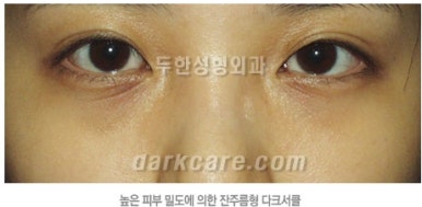 [두한성형외과 다크서클] - [하안검성형술] 관련 이미지 3