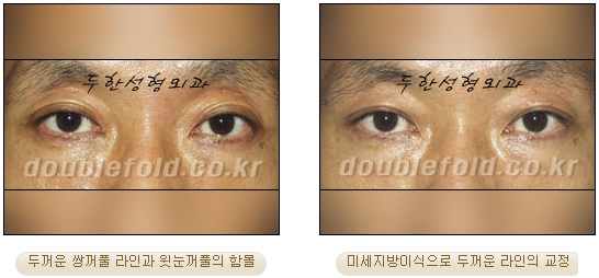 [Eye Reoperation Duhan Plastic Surgery] - [Guide to Double Eyelid Revision Surgery] image 43