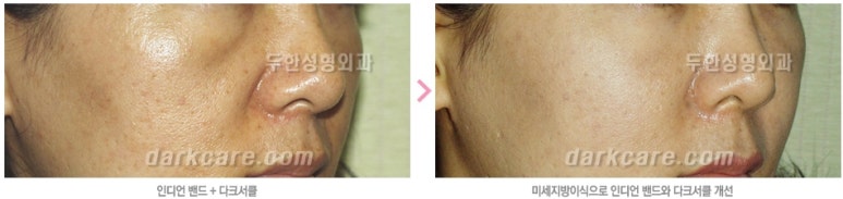 [두한성형외과 자가지방이식] - [인디언주름] 관련 이미지 29