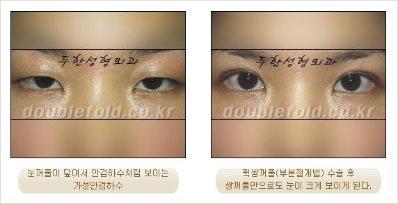 [두한성형외과 경쟁력 눈성형] - [안검하수(졸리운 눈매) 교정 방법 안내] 관련 이미지 16
