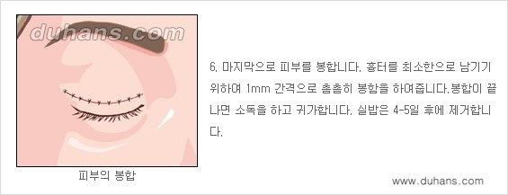[두한성형외과 성형 FOCUS] - [젊고 환한 눈매 상안검성형 안내] 관련 이미지 7