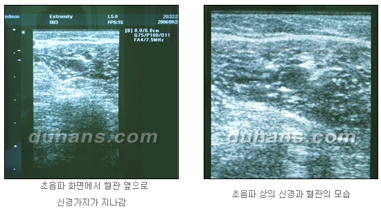 [두한성형외과 종아리축소술] - [초음파 유도 선택적 신경차단술 안내] 관련 이미지 13