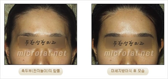 [두한성형외과 경쟁력 지방이식 리더] - [Col-fat(콜펫)지방이식, 3차원 입체지방이식, 2차원 평면지방이식] 관련 이미지 65