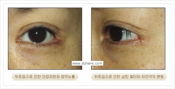[두한성형외과 경쟁력 쌍꺼풀 재수술, 극한 눈재수술] - [뒤트임 수술의 부작용 및 교정 방법 안내] 관련 이미지 6