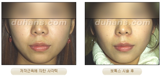 [두한성형외과 보톡스시술] - [사각턱 보톡스 안내] 관련 이미지 4