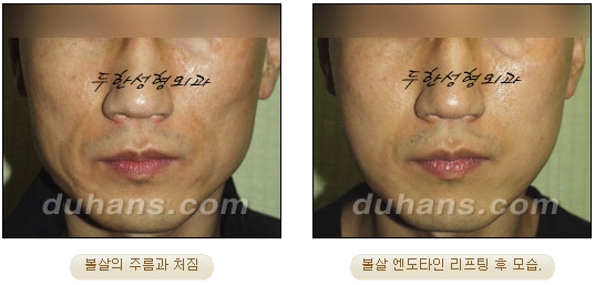 두한성형외과 안티에이징 리프팅 - 엔도타인 리프팅 관련 이미지 14