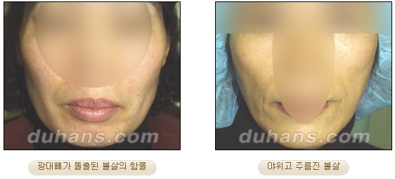 [두한성형외과 얼굴자가지방이식] - [볼살, 이마, 측두부] 관련 이미지 3