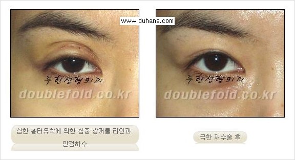 [두한성형외과 경쟁력 쌍꺼풀 재수술, 극한 재수술] - [재수술에서 극복해야 할 극한의 상황과 문제들 안내] 관련 이미지 13