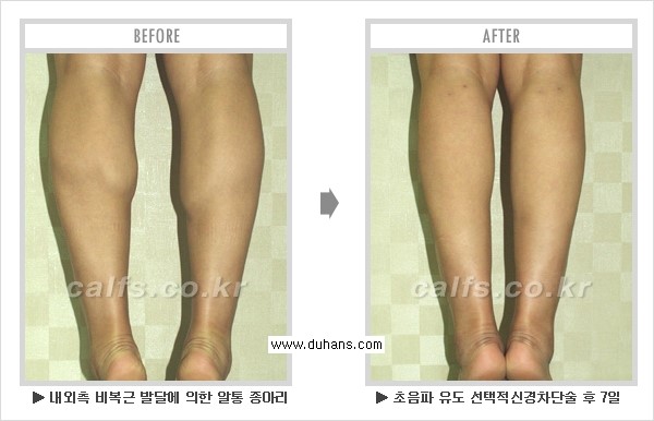 Dr. 컬럼 - 멀티 종아리 성형, 초음파 유도 비절개 선택적 신경차단술 관련 이미지 4