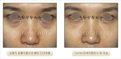 두한성형외과 눈밑수술 - 다크서클 수술 전후 관리 안내 관련 이미지 8