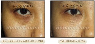 두한성형외과 눈밑성형 - 눈밑지방제거, 눈밑주름, 눈밑지방재배치 관련 이미지 90