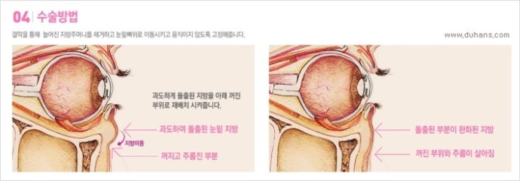 [두한성형외과 경쟁력 눈밑성형] - [눈밑 돌출과 그 아래 함몰주름선이 있는 다크써클 치료 방법 - 눈밑지방 재배치] 관련 이미지 2