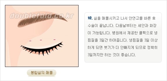 [두한성형외과 경쟁력 쌍꺼풀 재수술, 극한 재수술] - [쌍꺼풀 재수술의 과정 안내 2.] 관련 이미지 13