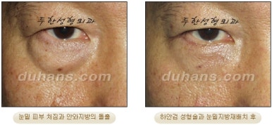 Blepharoplasty, Duhan Plastic Surgery - Upper and Lower Eyelids image 29