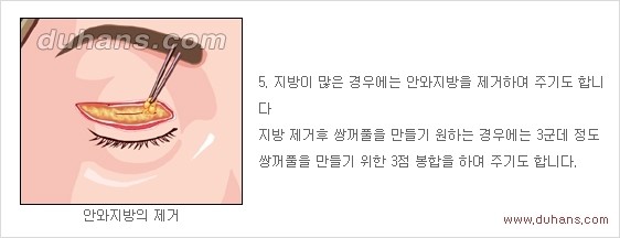 [두한성형외과 경쟁력 안검성형] - [젊고 아름다운 눈매 상안검 성형술 안내] 관련 이미지 5