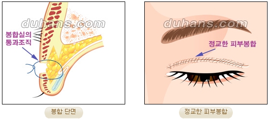 눈성형잘하는곳 두한성형외과 - 겹쌍꺼풀 관련 이미지 21