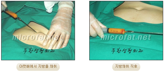 [Doohan Plastic Surgery Autologous Fat Grafting] - [Sunken Eye Fat Grafting] image 6