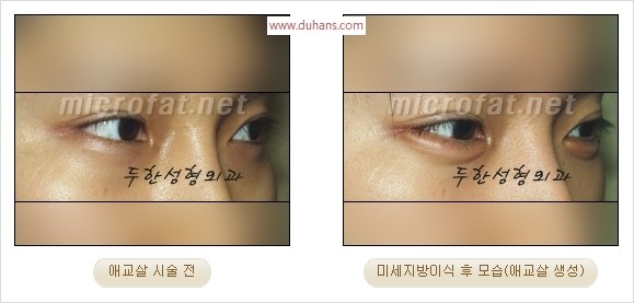 ​﻿[두한성형외과 경쟁력 지방이식] - [눈밑 애교살 시술을 위한 미세지방이식] 관련 이미지 33