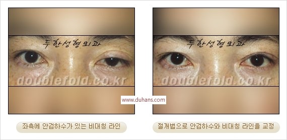 [두한성형외과 경쟁력 눈성형] - [안검하수(졸린눈매) 눈매교정 여러 가지 방법 안내] 관련 이미지 20