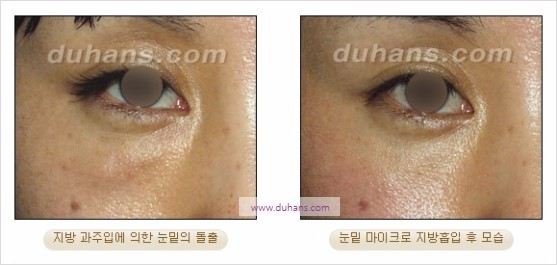 [두한성형외과 경쟁력 지방흡입] - [볼살, 턱선의 간편 지방흡입] 관련 이미지 29