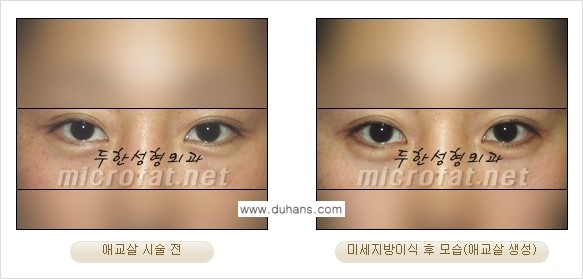 [두한성형외과 경쟁력 눈밑성형] - [눈밑 다크써클과 눈밑 애교살과의 관계 1.] 관련 이미지 5