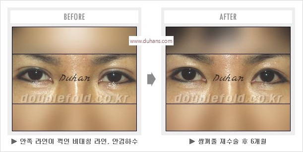 [두한성형외과 경쟁력 눈성형] - [나에게 맞는 어울리는 쌍꺼풀 라인] 관련 이미지 13