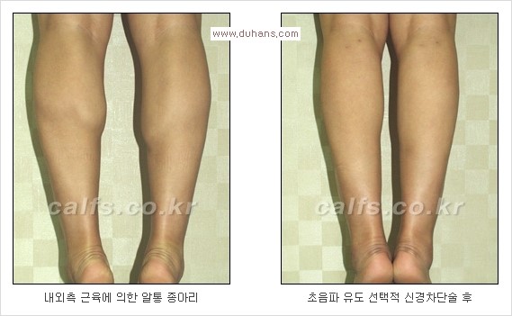 [두한성형외과 Dr. 컬럼] - [종아리 근육퇴축술로 가장 선호하는 비절개 초음파 유도 선택적 신경차단술] 관련 이미지 15