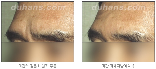 [두한성형외과 주름교정] - [주름개선 지방이식] 관련 이미지 16