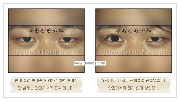 [두한성형외과 경쟁력 쌍꺼풀 재수술(극한 재수술)] - [안검하수(졸리운 눈매) 교정 안내 1.] 관련 이미지 6