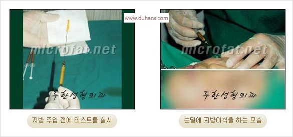 [두한성형외과 경쟁력 미세지방이식] - [애교살 필러 시술의 부작용 교정] 관련 이미지 8