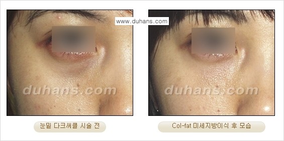 [두한성형외과 경쟁력 미세지방이식] - [탄력있는 피부와 윤곽을 만들어주는 Col-fat 지방이식] 관련 이미지 8