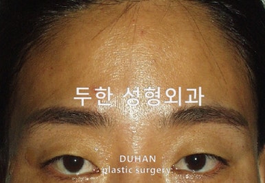 [Duhan Plastic Surgery Forehead Surgery] - [Forehead Fat Grafting for Forehead Surgery] image 16