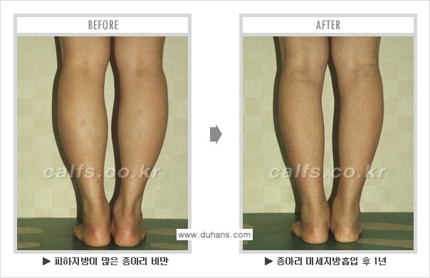 [두한성형외과 매력적인 종아리 만들기!] - [정교한 흡입 - 미세흡입관 지방흡입술 3.] 관련 이미지 11