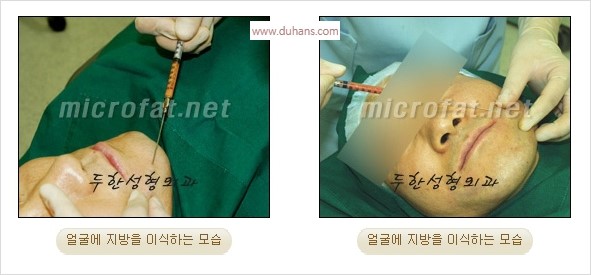 ⁠⁠[두한성형외과 경쟁력 윤곽성형] - [볼, 볼살 지방이식의 효과] 관련 이미지 8