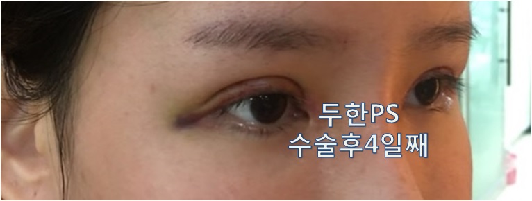 [두한성형외과 쌍꺼풀재수술]-[#라인키우기 #비대칭 #낮은라인 #울퉁불퉁 #짝눈] 관련 이미지 4