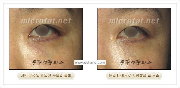 [두한성형외과 겨울엔 지방흡입을] - [볼살, 눈밑, 턱선의 초음파 미세지방흡입 1.] 관련 이미지 6
