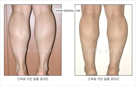 [두한성형외과 경쟁력 멀티종아리성형] - [종아리 근육 퇴축술에 관한 질문과 답변] 관련 이미지 19