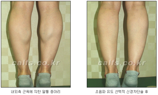 [두한성형외과 종아리퇴축술] - [NO절개! 초음파유도신경차단술] 관련 이미지 21