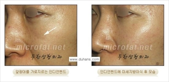 [두한성형외과 경쟁력 귀족성형] - [3차원 입체 미세지방이식 귀족수술 + 인디언밴드 교정] 관련 이미지 25