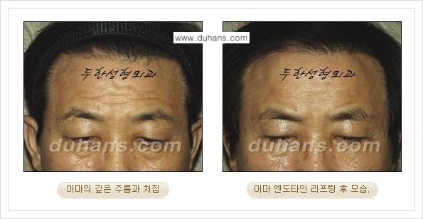 [두한성형외과 경쟁력 주름성형] - [엔도타인 리프팅 안내 ②] 관련 이미지 16