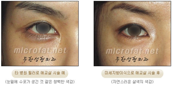 [두한성형외과 지방이식] - [다크서클, 눈밑주름] 관련 이미지 94