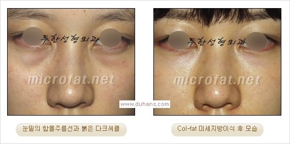 [두한성형외과 경쟁력 눈밑성형] - [눈밑 미세지방이식으로 다크써클 치료] 관련 이미지 18