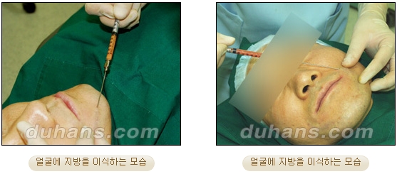 [두한성형외과 얼굴자가지방이식] - [볼살, 이마, 측두부] 관련 이미지 7