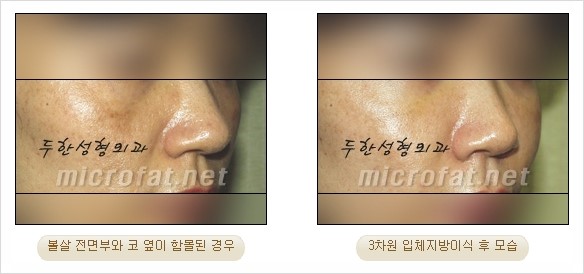 [두한성형외과 경쟁력 지방이식 리더] - [Col-fat(콜펫)지방이식, 3차원 입체지방이식, 2차원 평면지방이식] 관련 이미지 44
